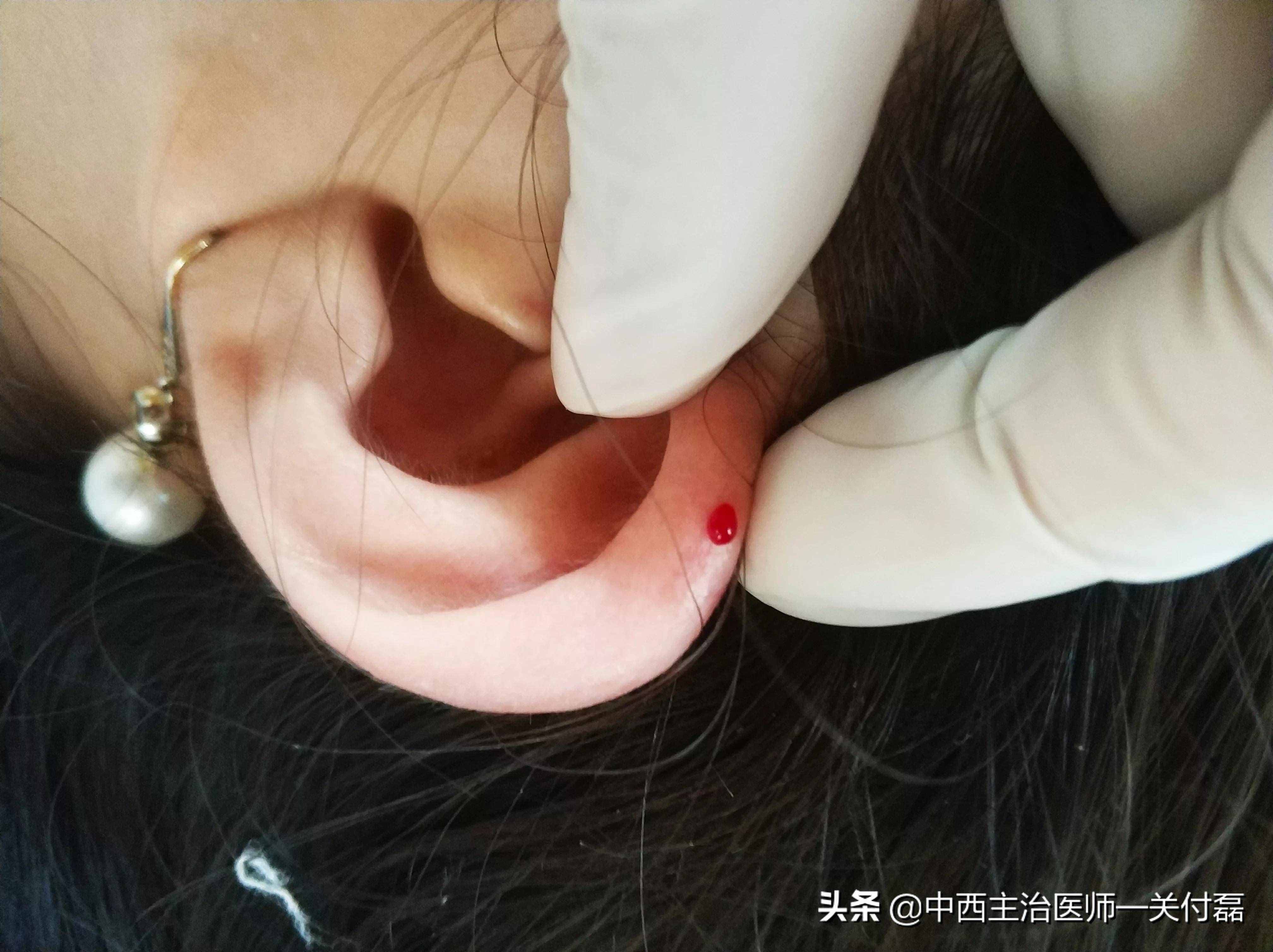 耳尖放血疗法（中医有个简单有效的耳尖刺血疗法）