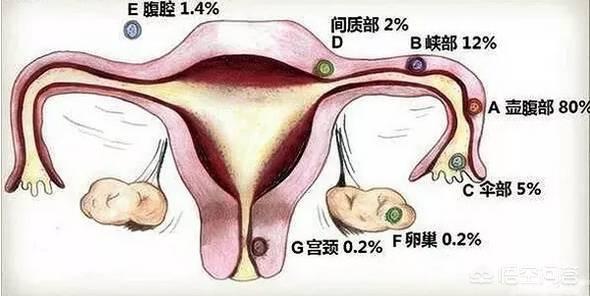 宫外孕早期的七个征兆（怎样辨别宫外孕的症状）宫外孕有哪些症状??