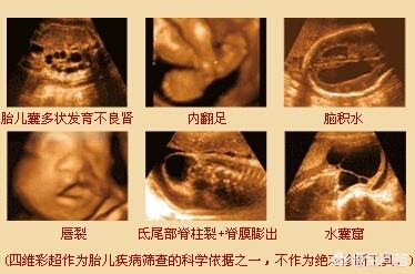 胎儿畸形的10大征兆（胎动正常大排畸会有问题吗）