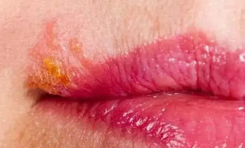 为什么每年嘴唇都长一次疱疹（感冒了嘴唇疱疹用什么药）